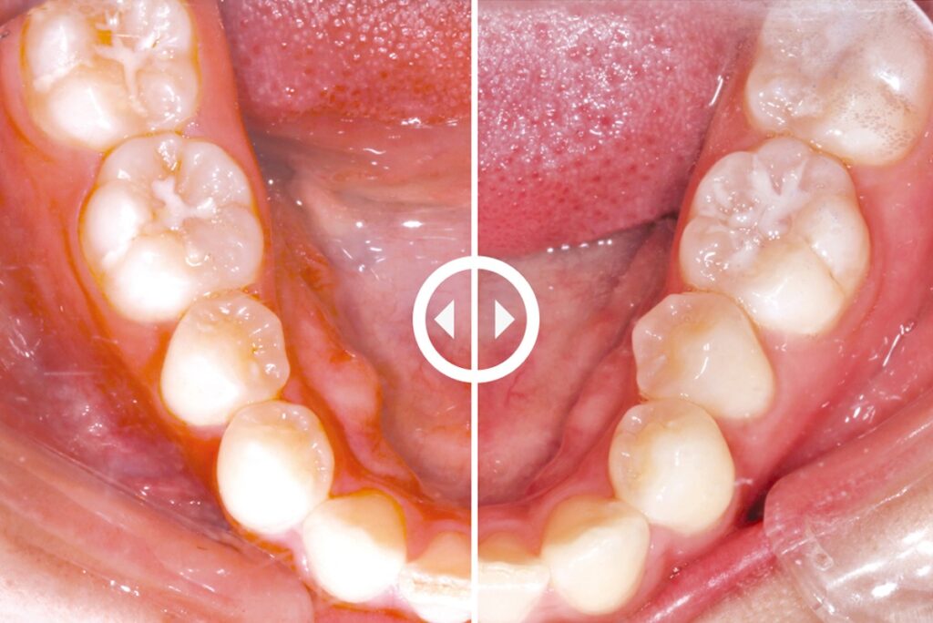 The Simple Anterior Crowding Case